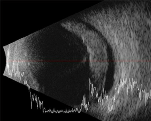 اسباب ضعف النظر المفاجئ  انفصال الشبكية