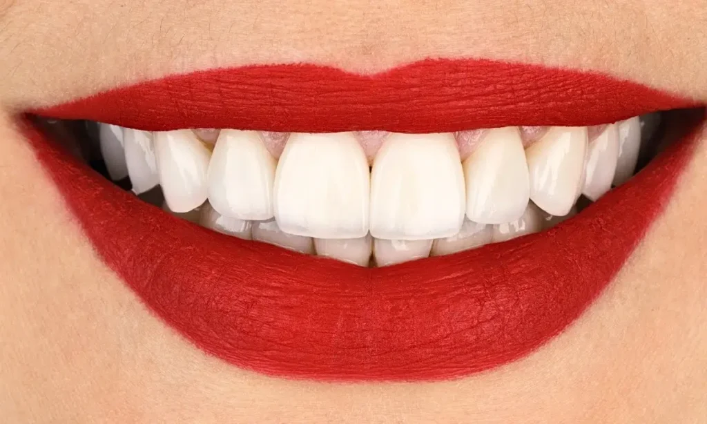 ابتسامة هوليود