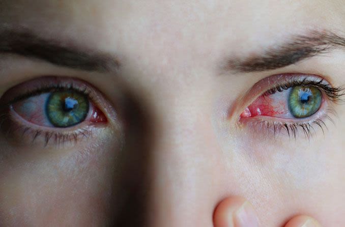 امراة تعاني من حساسية العين واحمرارها