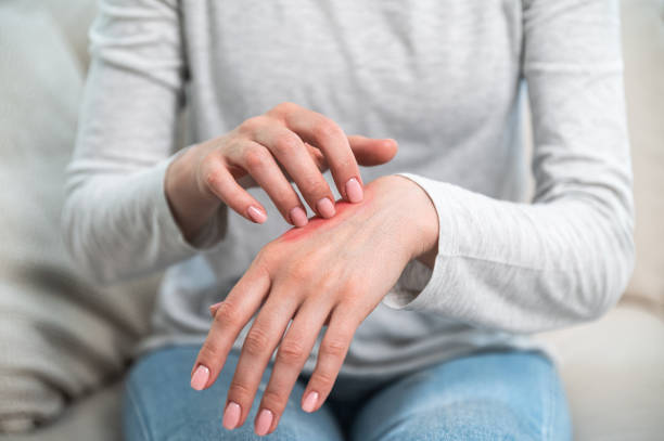 الآثار الجانبية لكريم ترايميلزما